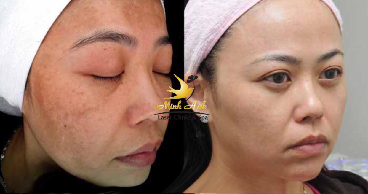 Khách hàng trước và sau khi điều trị nám tại Minh Anh Laser Clinic & Spa.
