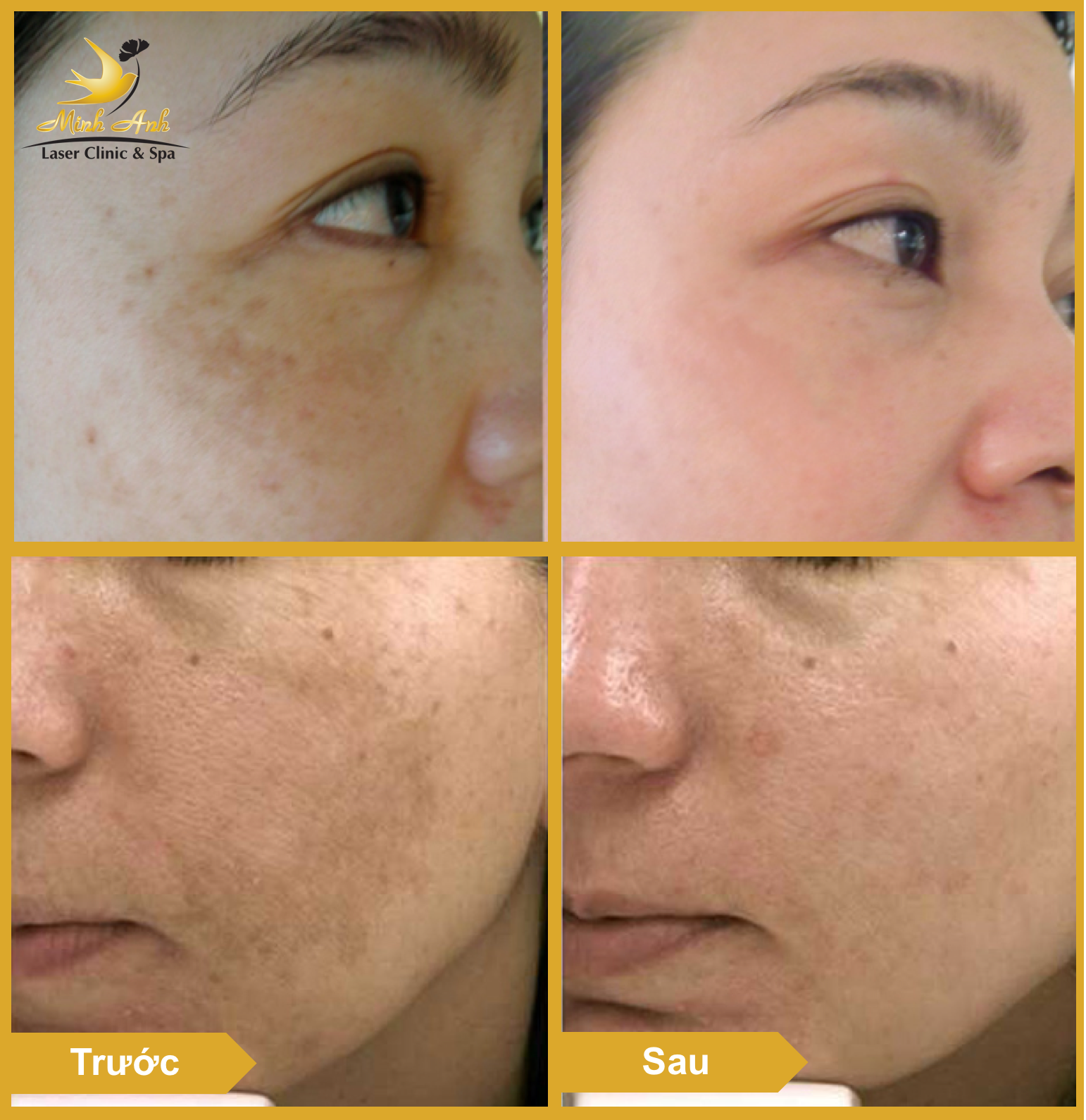 Hình ảnh khách hàng sau liệu trình trị nám tại Minh Anh Laser Clinic & Spa